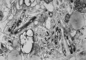 Whipple disease Whipple disease